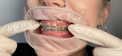 braces.fetish nude